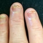 chemo nagels
