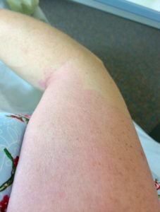 mijn arm na de borst operatie