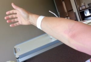 mijn arm na de borst operatie