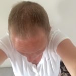 haar na chemo